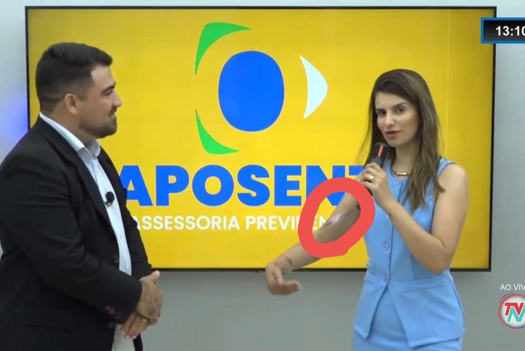 Gii Babado aparece com queimadura no braço