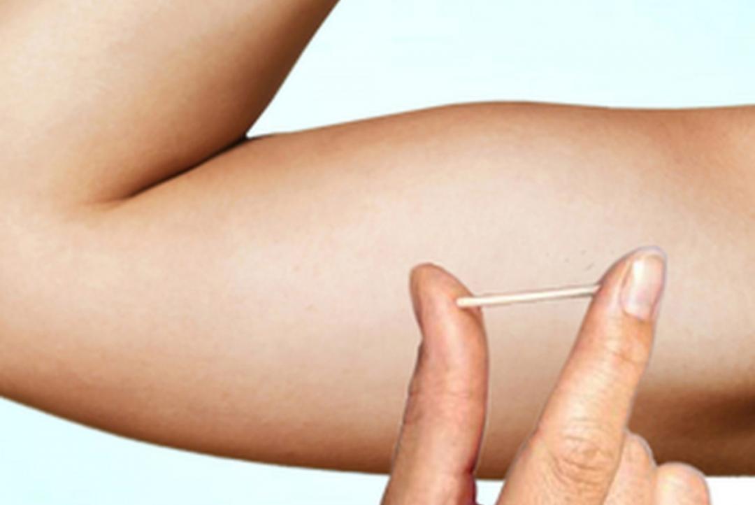 IMPLANON: Implante contraceptivo agora no SUS