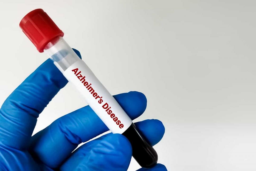 Novo teste de sangue pode prever Alzheimer até 20 anos antes dos sintomas