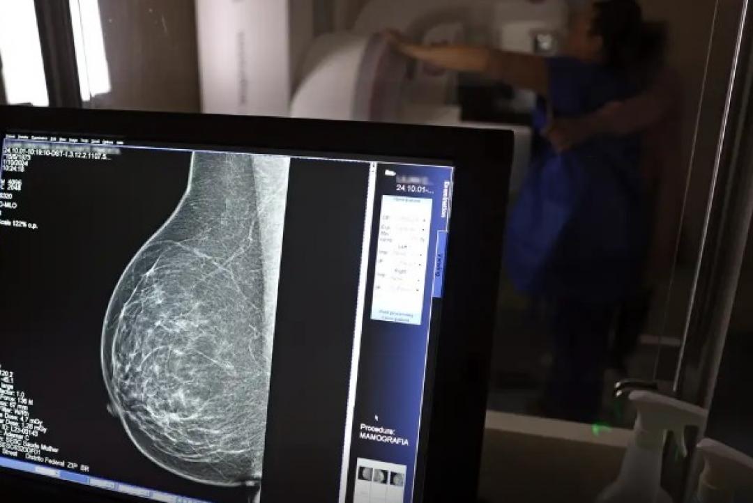Periodicidade de mamografias divide médicos e autoridades de saúde